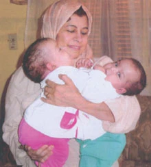 Siamese Twins Set for Separation