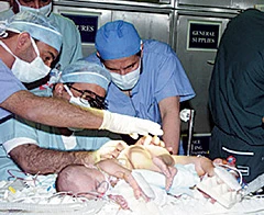 Twins Separated Successfully