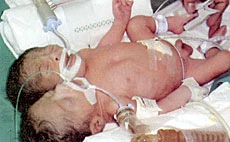 Officials Told to Consider Surgery on Saudi Twins
