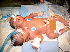 Conjoined Saudi Twins Die
