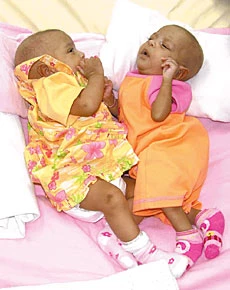 Egyptian Twins Shifted From ICU