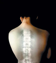 Osteoporosis - Now Affecting the Young