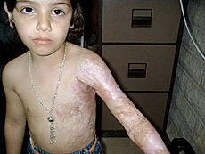 Palestinian Girl Being Treated for Burns in Dubai Hospital