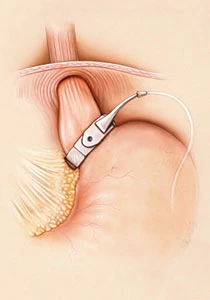 Lap-Band Surgery: A Weighty Decision