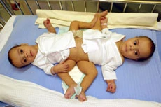 Al-Rabeeah’s team to separate Egyptian twins on Saturday