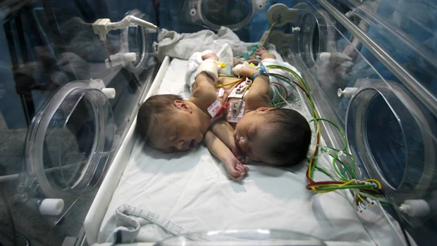 Inseparable ... even in death: Gaza twins lose battle for life