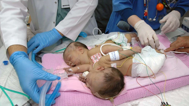Gazan twins’ condition critical, doctors say