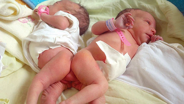 King orders separation of Algerian conjoined twins