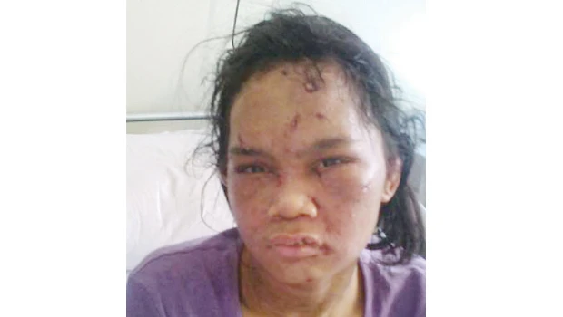 Another abused maid admitted to Madinah hospital