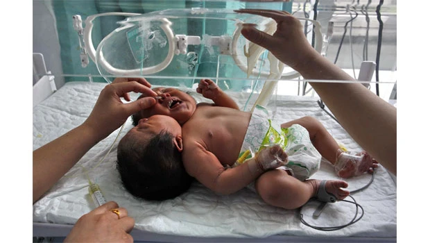 Chinese twins born in single body with 2 heads