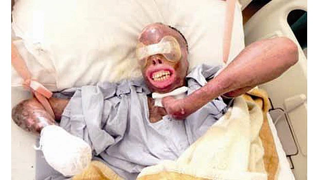 Fire victim to be treated in the US