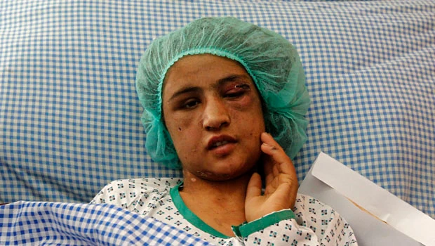 Tortured Afghan girl to go to India for treatment