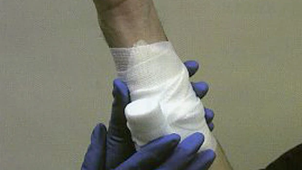Controlling bleeding