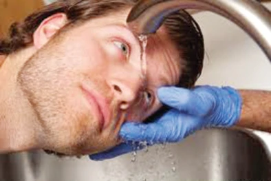 Caring for chemical burns