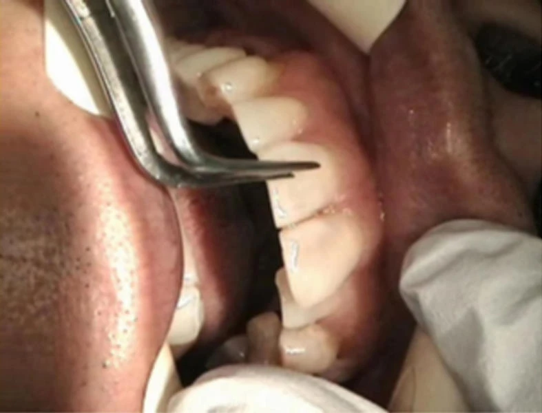 Japan tooth patch could be end of decay