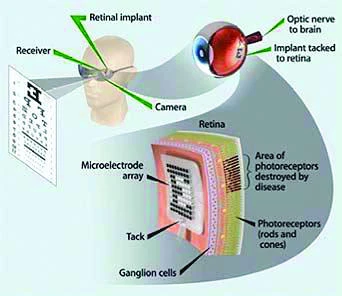 Bionic eye gives hope to the blind