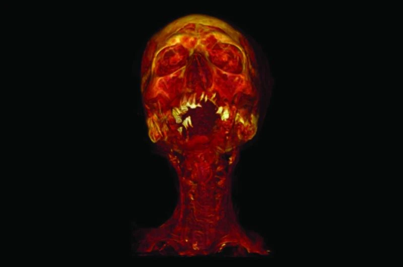 Study: Even ancient mummies had clogged arteries, CT scans show