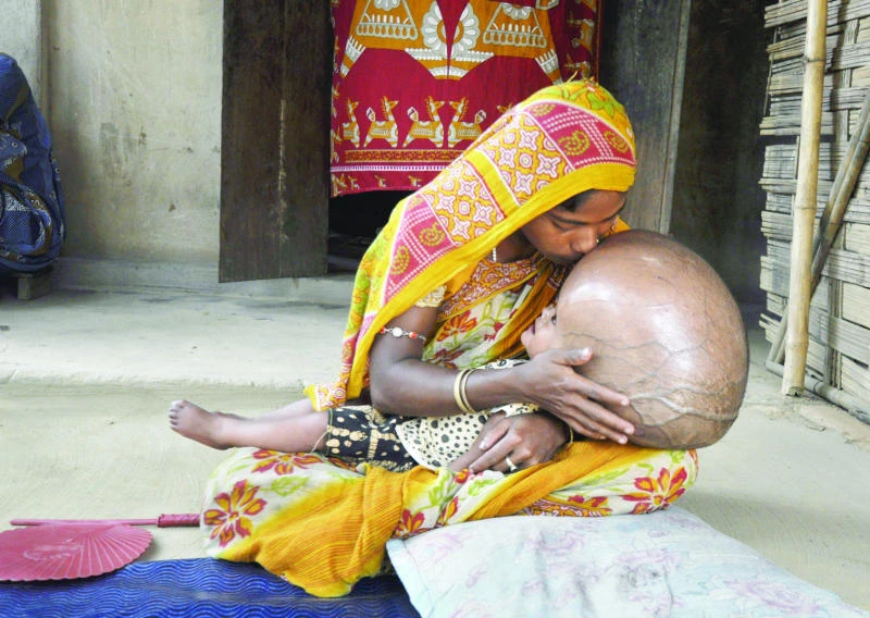 Indian girl with swollen head needs a ‘miracle’