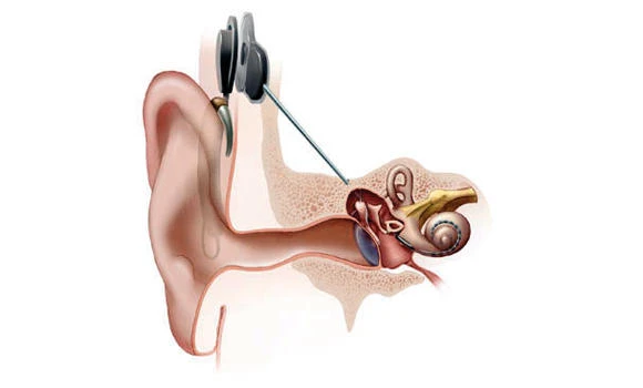 Saudi doctors implant electrodes into toddler’s brainstem