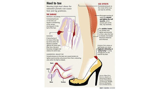 Ouch! High-heeled shoes may look good, but they’re killing your feet