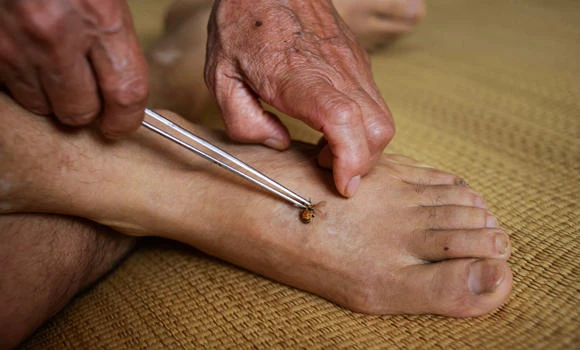 Bee sting therapy causing a buzz in China