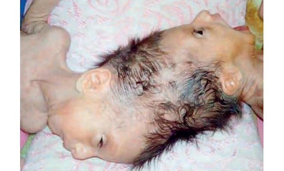 Operation ordered by king to separate Syrian Siamese twins
