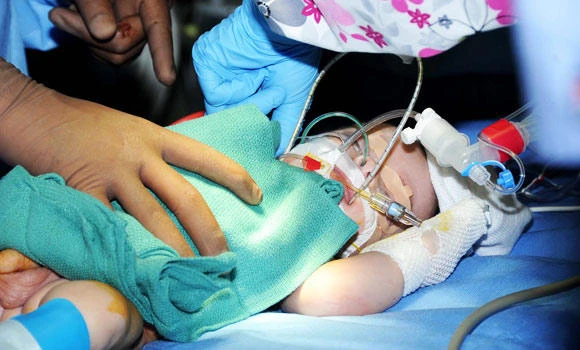 Separated twins in stable condition