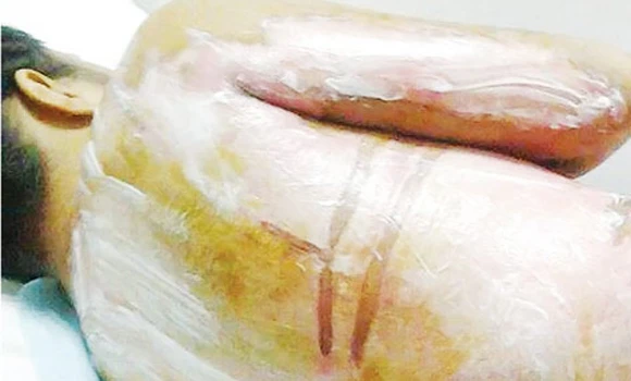 Images of scalded Filipino maid in Riyadh go viral