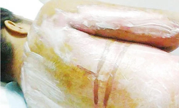 Scalded woman’s case under police probe