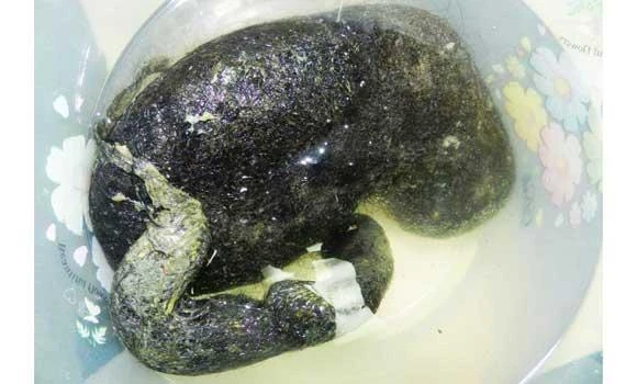 Massive hair lump removed from patient’s stomach