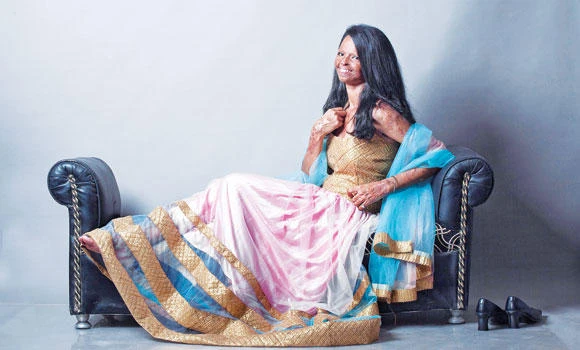 Acid victims’ photo shoot draws attention in India
