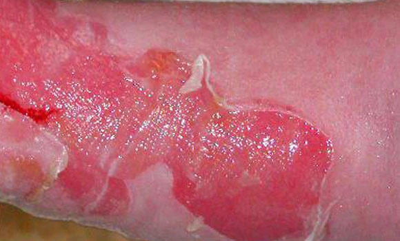 Siblings seek treatment for rare skin disease
