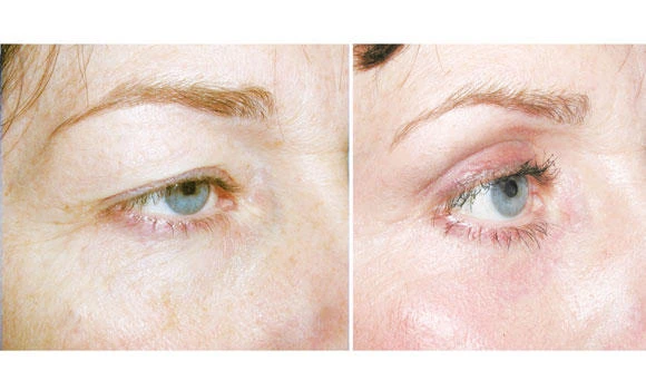 Eyelid surgery: What you should know