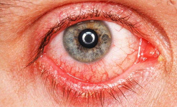 Cold gives Pink Eye blues