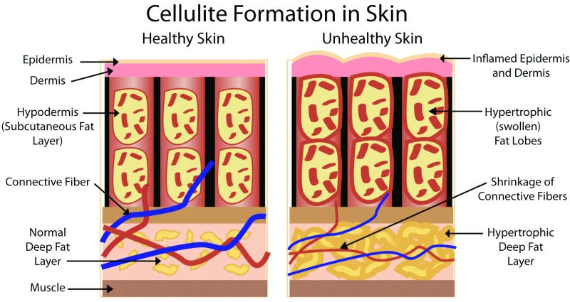 Fight and win cellulite battle