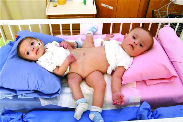 KAMC surgeons to separate Yemeni twins