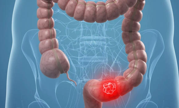 Citizens warned against rising colon cancer cases