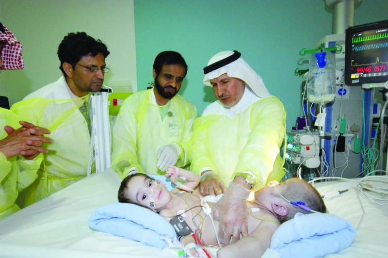 Yemeni conjoined twins to be separated tomorrow
