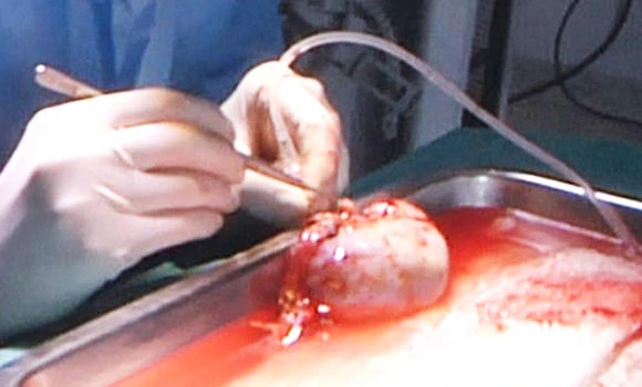 Yemeni’s kidney was not stolen: Health department