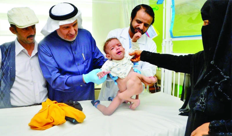 Yemeni parasitic twin to undergo surgery in KSA