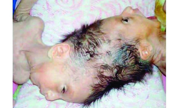 Conjoined twins to be separated on Sunday