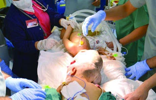 Syrian conjoined twins undergo 18-hour marathon operation
