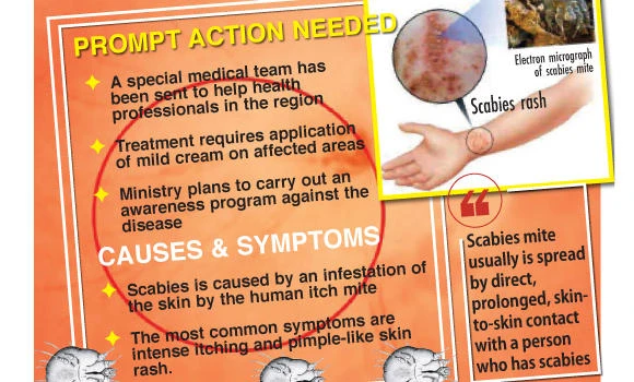 Nine fall ill with scabies