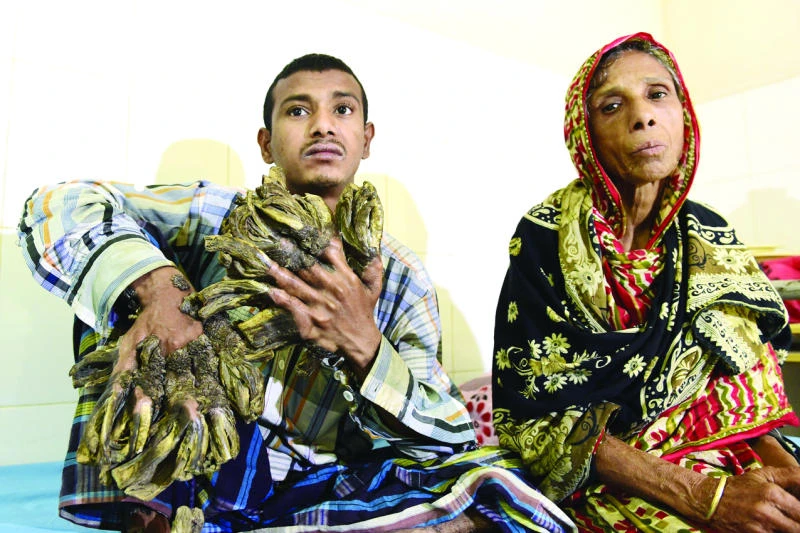 Bangladesh’s ‘Tree Man’ undergoes successful surgery