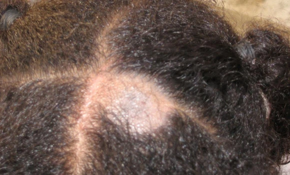 Peculiar skin disease
attacks schoolchildren