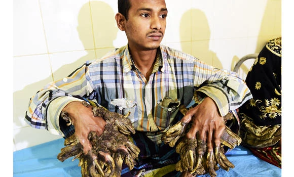 Bangladesh ‘Tree Man’ may need dozen more operations
