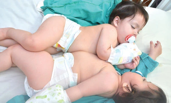Pak twins set for surgery; KSA thanked