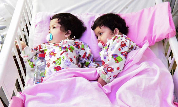 Pak twins stable after separation