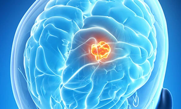 Huge tumor removed from woman’s brain