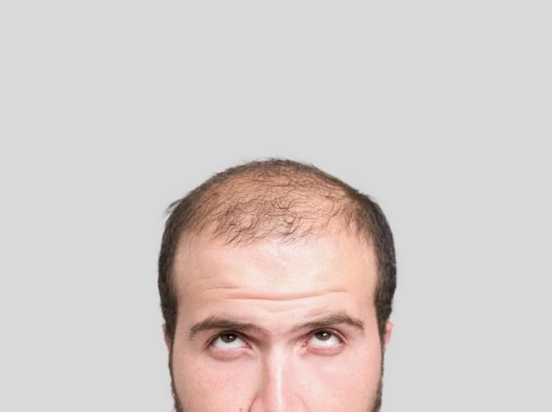 Short, white men more likely to go bald: study